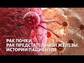 Рак почки и предстательной железы. Доктор Каприн