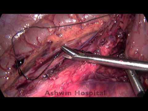 Laparoscopic APR [ Abdominoperineal Resection ]