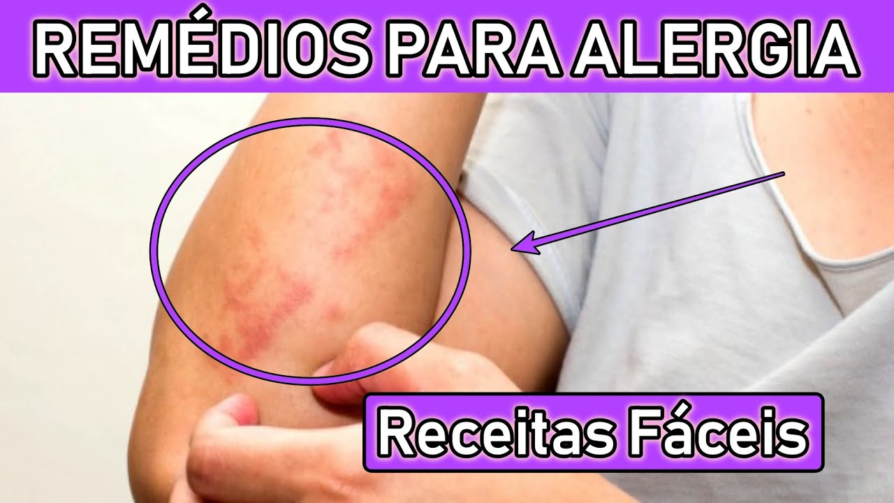 Remédio Caseiro Para Alergia Na Pele Que Coça Muito Infantil - RETOEDU