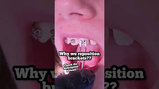 Is it common to get stains with Braces? Why we reposition brackets? Tooth Time Dentist New Braunfels