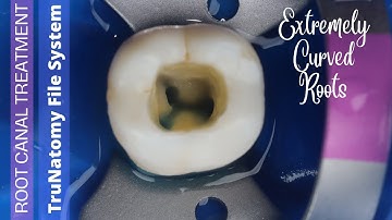 Root Canal Treatment in Mandibular Molar ⚪️ TruNatomy Endodontic File System (Denstsply) 🟡