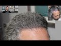 Does a Hair Transplant Look Natural? | Feller & Bloxham Medical | NY, NYC, Long Island