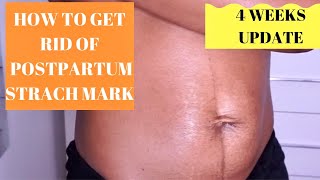 Get Rid Of Stomach Stretch Mark With This My 4 weeks Update