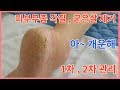 개운하게 지인의 피부무좀 발각질제거, 뒤꿈치 굳은살 제거 하기!!  깔끔해져요 ^^