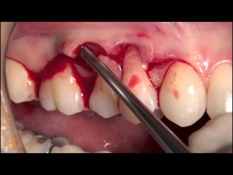 cv-50-treatment-of-single-moderate-gingival-recessions...-preview