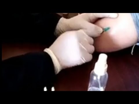 طريقة الحقن تحت الجلد ازاى تحقنى نفسك أو حد فى العائله مصاب بالسكر   