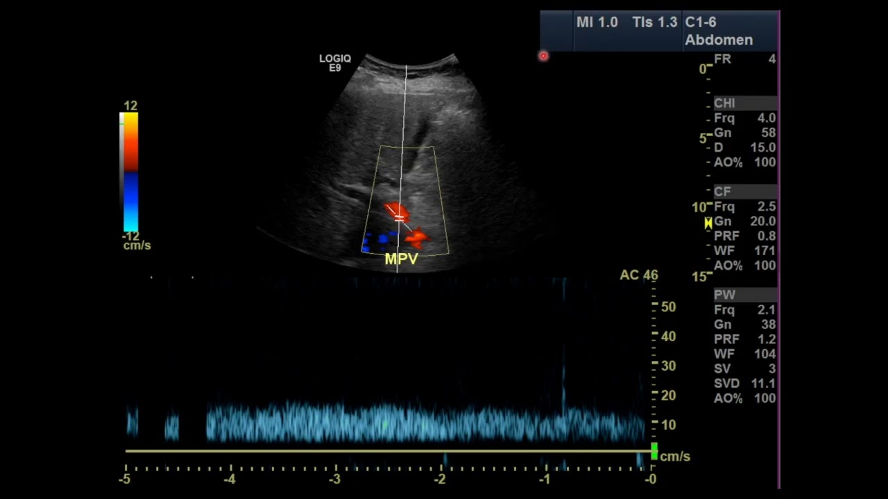 Understanding ultrasound parameters: mechanical index and thermal index