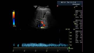 Understanding Ultrasound Parameters Mechanical Index And Thermal Index