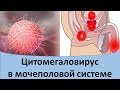 Цитомегаловирус в мочеполовой системе.