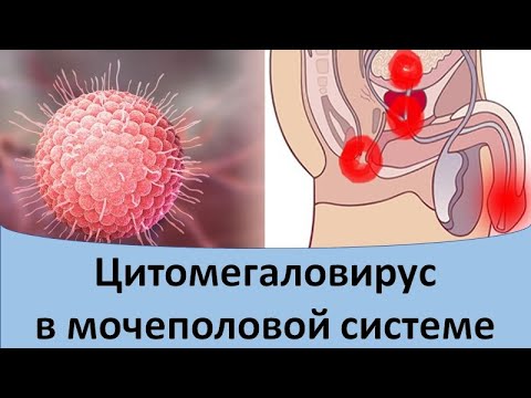 Video: Cytomegalovirus Pada Lelaki, Gejala Dan Rawatan