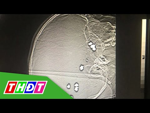 Video Bé trai 6 tuổi ở Hòa Bình bị 11 v.iê.n đ.ạn ghim vào... - youtube