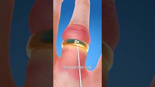 Yüzüğünüz Parmağınıza Sıkıştıysa Bunu Deneyin 💍🧵