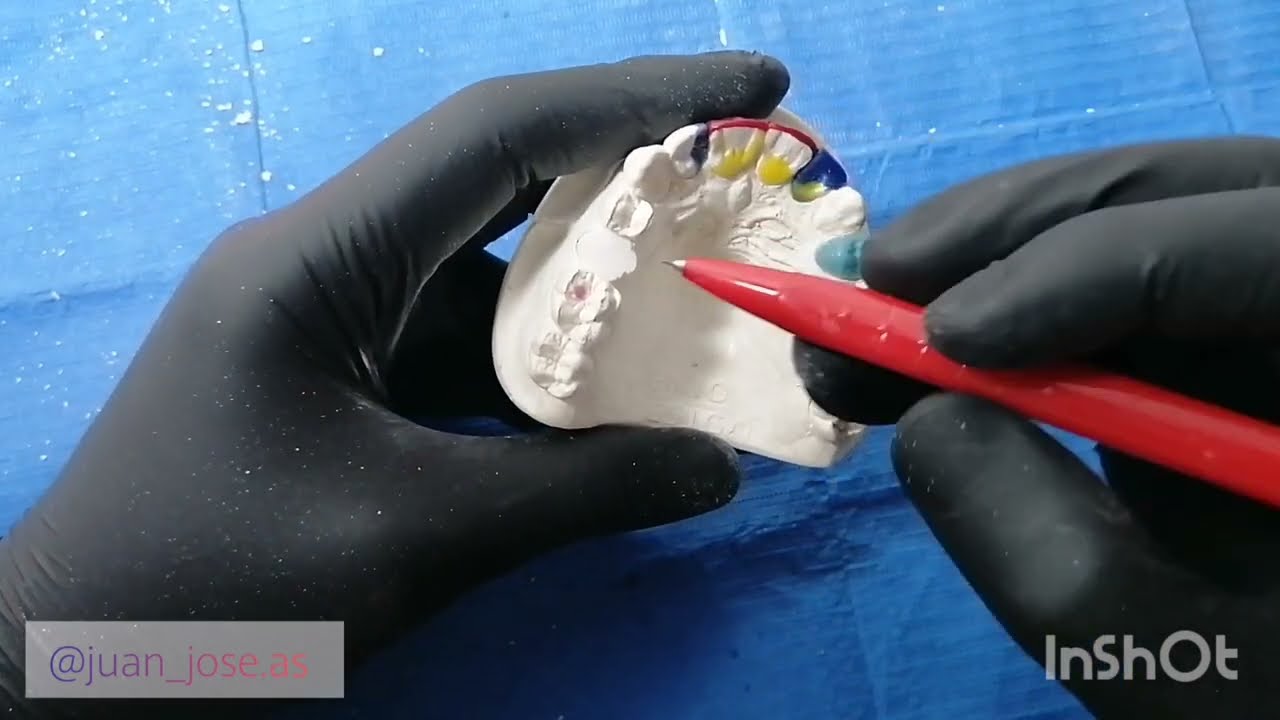 Encerado de segundo Premolar superior