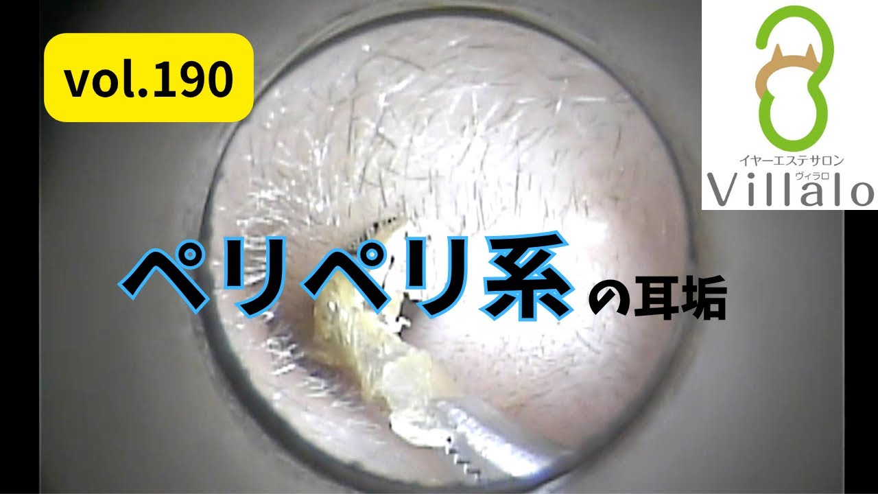 耳掃除 vol.190「ペリペリ系の耳垢」