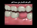 ايه هو تأثير فقد الأسنان علي صحة الفم والأسنان 