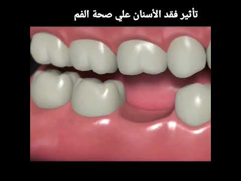 ايه هو تأثير فقد الأسنان علي صحة الفم والأسنان