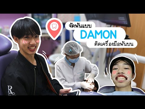 Ep1 ติดเหล็กจัดฟันคุณหมอทำอะไรกับช่องปากผมบ้าง| จัดฟันแบบดามอน | damon system | 101SmileDentalClinic