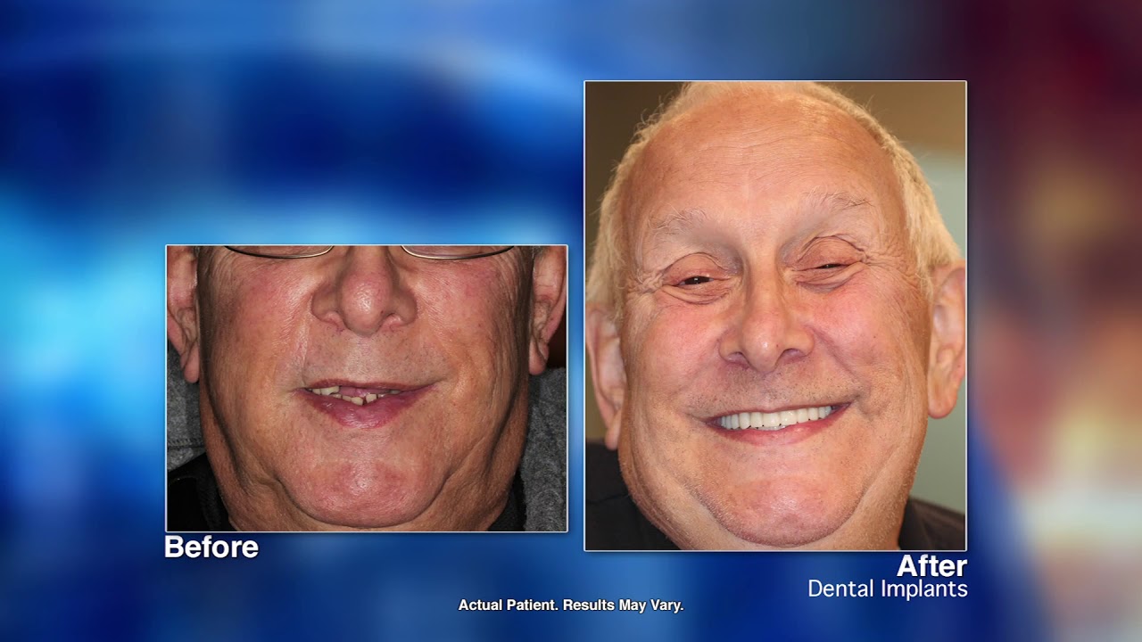 Replacing Missing Teeth with Dental Implants with Jacksonville, FL