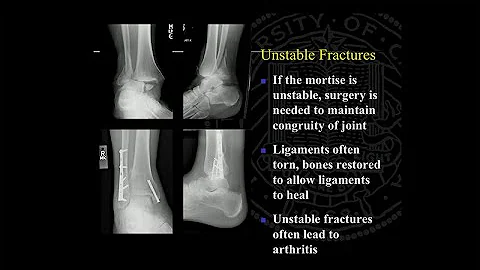 Ankle Replacement and Ankle Fusion: Surgery and Recovery