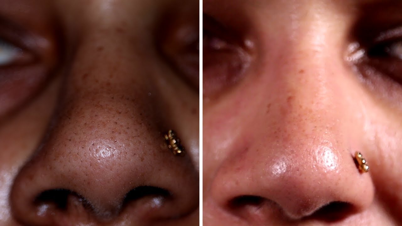 remove-blackheads-instantly-live-results-youtube