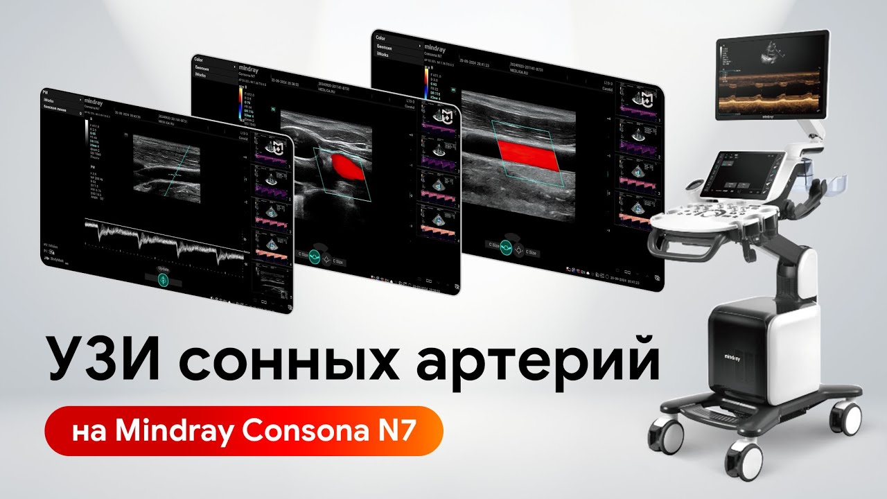 Сканирование сонных артерий на Mindray Consona N7