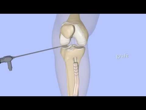Acl Reconstruction Youtube