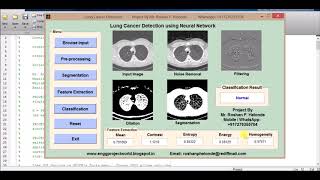 Lung Cancer Detection using neural network Image processing project | Lung Cancer Prediction News