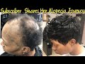 Severe Alopecia Sew In | Subscriber Free Transformation ( Listen to her Alopecia Journey)