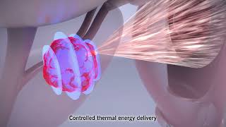 Focal One® High-Intensity Focused Ultrasound