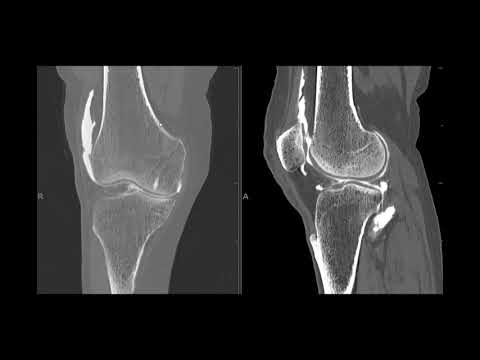 Video: Was ist ein CT-Arthrogramm des Knies?