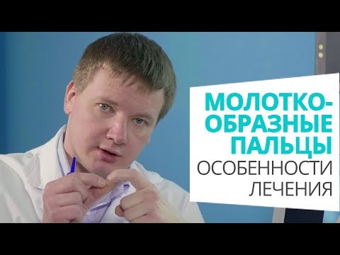 Молоткообразные пальцы: особенности лечения доктор Алексей Олейник #footclinic