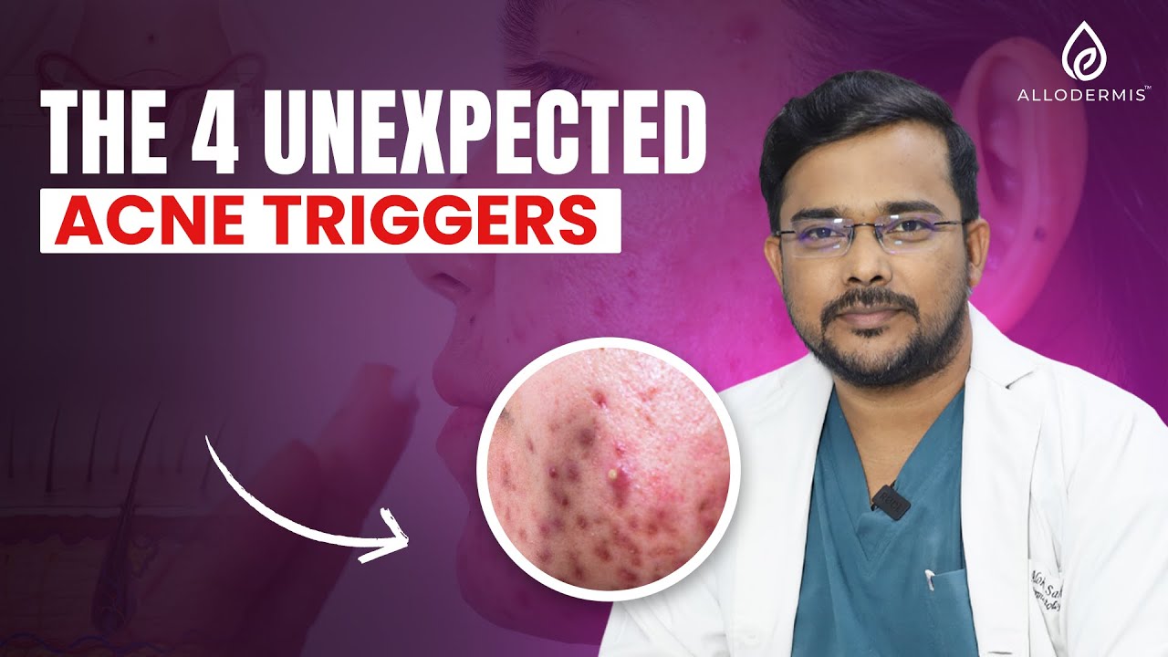 The 4 Hidden Triggers Causing Your Persistent Adult Acne