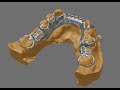 Beautiful Digital Dental Partial Design