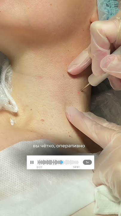 Отзыв пациента на удаление папиллом лазером 🔎 #родинки # ...