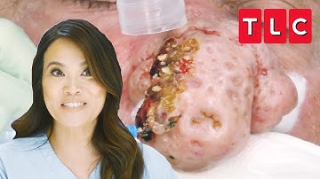 Terry’s Large Cyst on His Nose Causes Blocked Breathing | Dr. Pimple Popper | TLC
