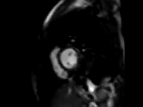 Assessment of ventricular coupling with real-time cine MRI and its ...