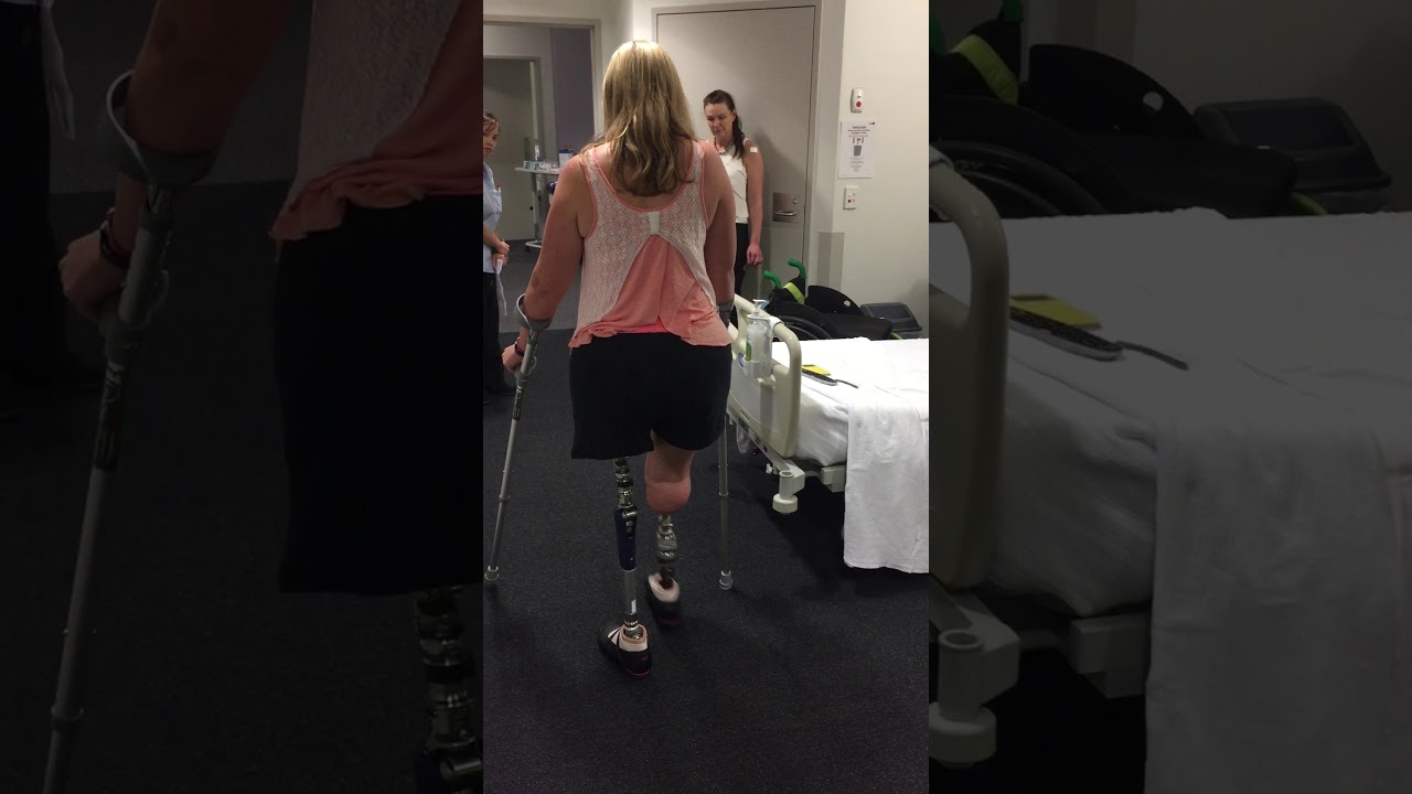 Below knee and above knee amputation and osseointegration | Dr Munjed Al Muderis Patient