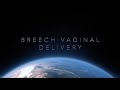 Breech Vaginal Delivery