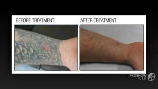 Ink Undone Tattoo Removal Clinic – Remove Tattoo with advanced laser technology