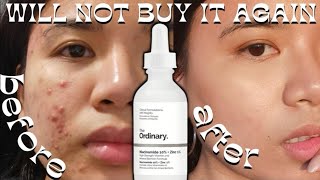 6 MONTHS OF THE ORDINARY NIACINAMIDE I will stop using it on my acne skin not a clickbait