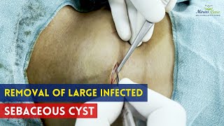 Removal of Large Infected Sebaceous Cyst | Sebaceous cyst treatment in Delhi NCR