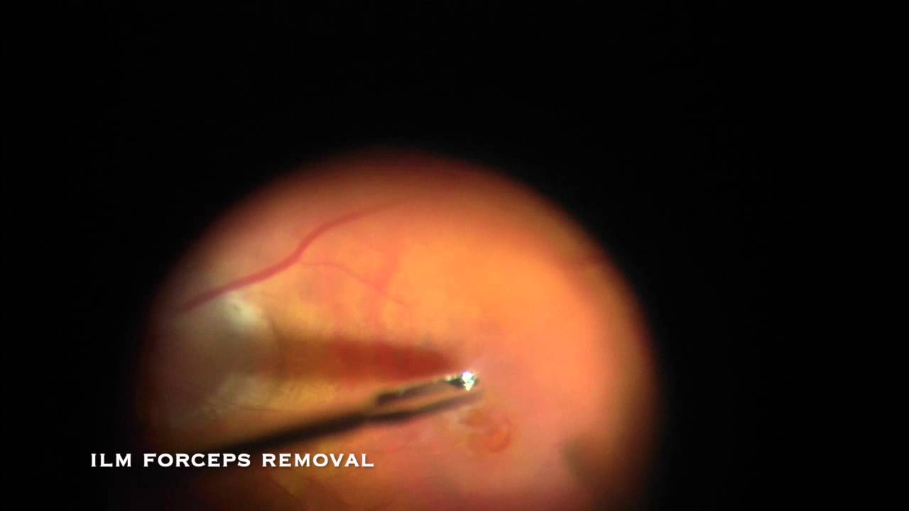 Epiretinal Membrane Removal In Recurrent Macular Hole Using Alcon Flex Loop Epiretinal Membrane Removal In Recurrent Macular Hole Using Alcon Flex Loop