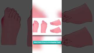 Overlapping Toes: Causes and Solutions #shorts