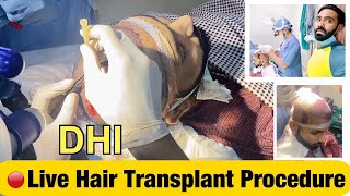 Live Hair Transplant Procedure | Best Hair Transplant Surgery in India | Step by Step details