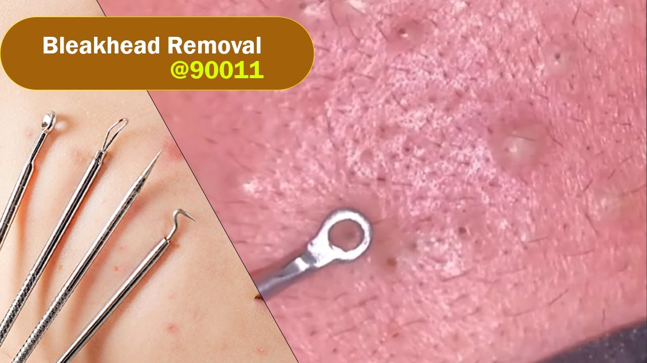 𝘽𝙞𝙜 𝙘𝙮𝙨𝙩𝙞𝙘 𝙖𝙘𝙣𝙚 𝙗𝙡𝙖𝙘𝙠𝙝𝙚𝙖𝙙 𝙚𝙭𝙩𝙧𝙖𝙘𝙩𝙞𝙤𝙣 𝙗𝙡𝙖𝙘𝙠𝙝𝙚𝙖𝙙 900011 YouTube