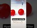 Hyaluronic acid filler #pdofacelift #pdothreads #filler #fillertreatment #fillersinjection #love