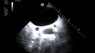 Bladder Diverticulum, US  JETem 2020