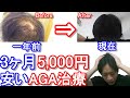 【AGA】3ヶ月5,000円で薄毛を改善できる方法を解説します