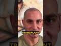 Scalp Micropigmentation & Hair Transplant: Which First? 🤔