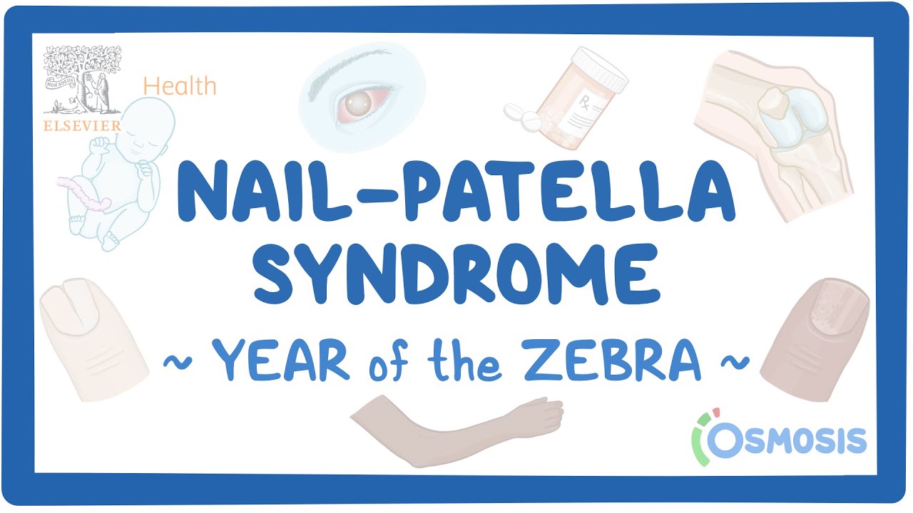 Congenital Dislocation of Patella - Pediatrics - Orthobullets